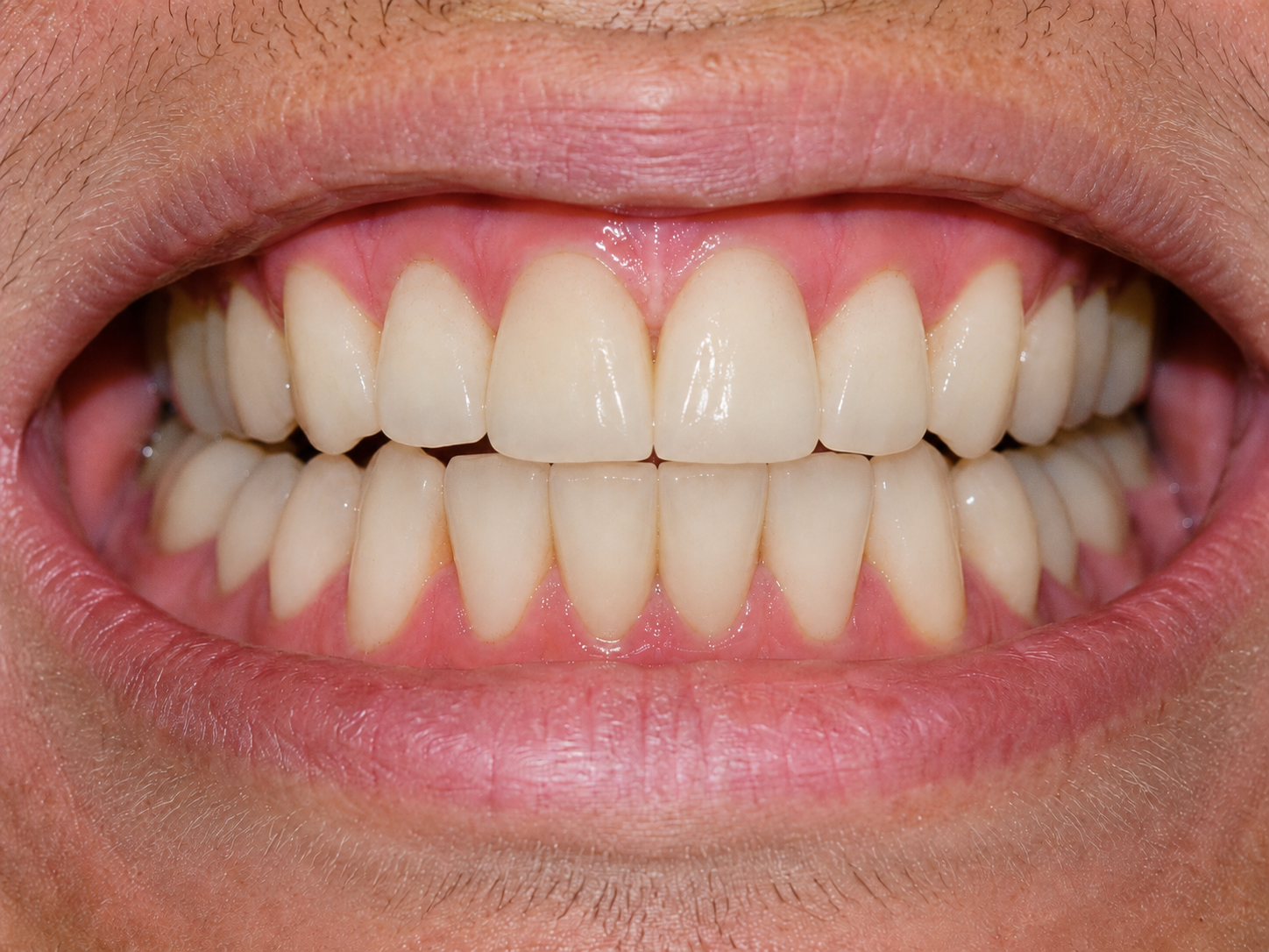 Rezultatul dentar după tratament, cazul 02