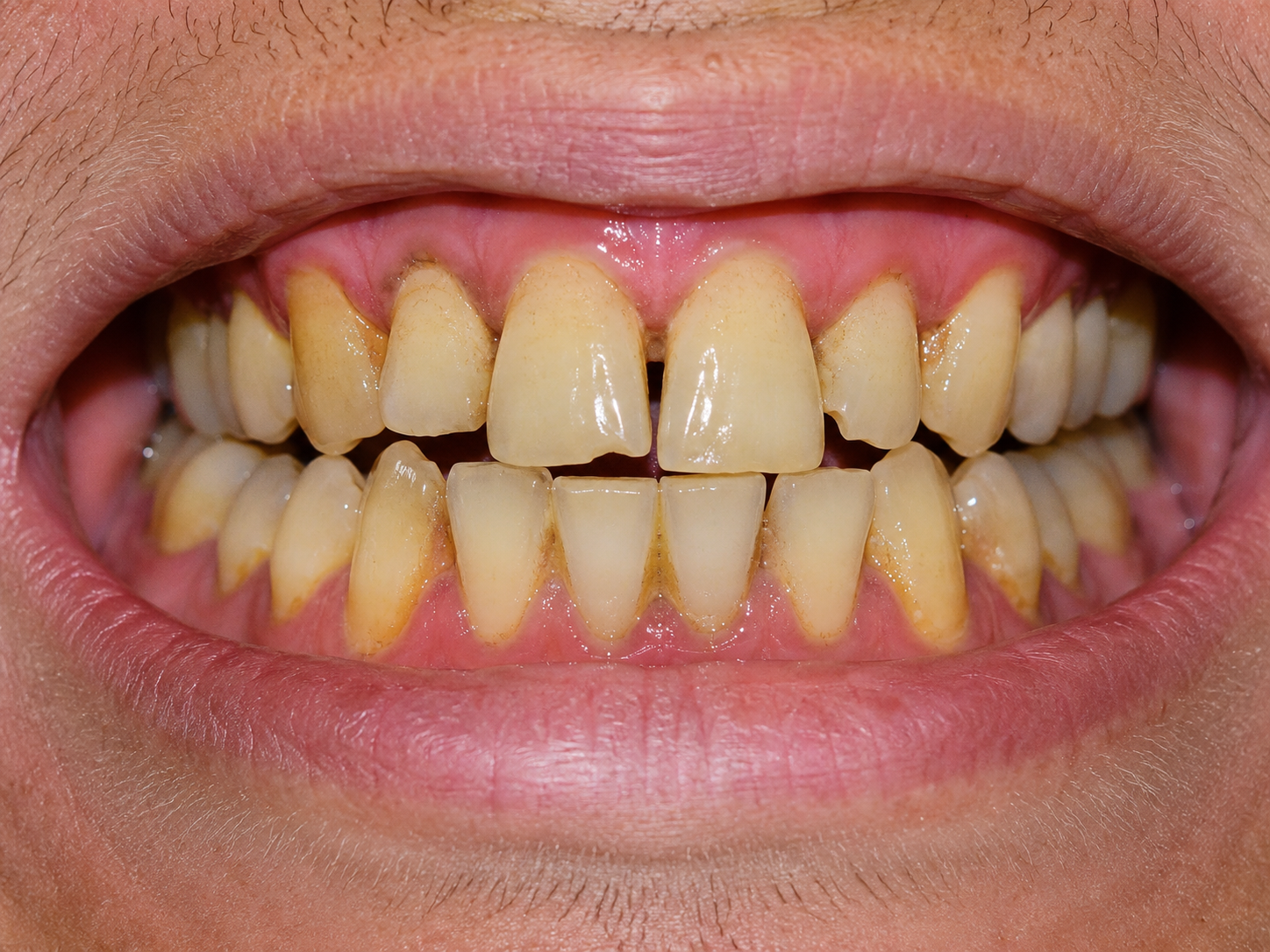 Situația dentară înainte de tratament, cazul 02